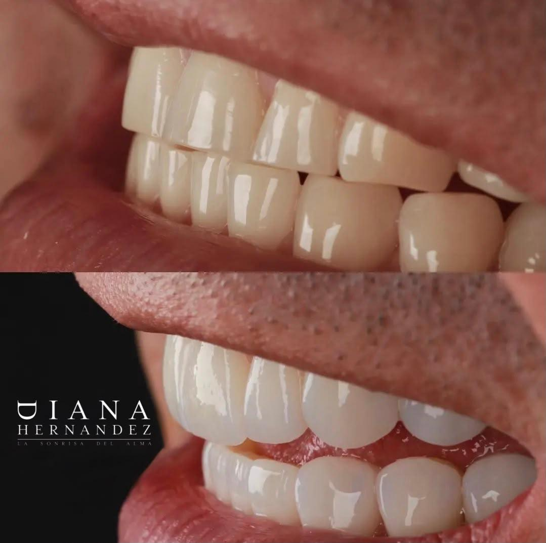 Resultado clínico de diseño de sonrisa · DH Studio Dental